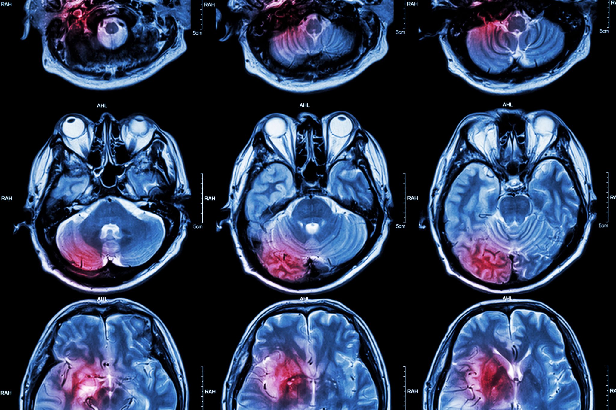 Photo of an MRI Film Showing Potential Brain Injury